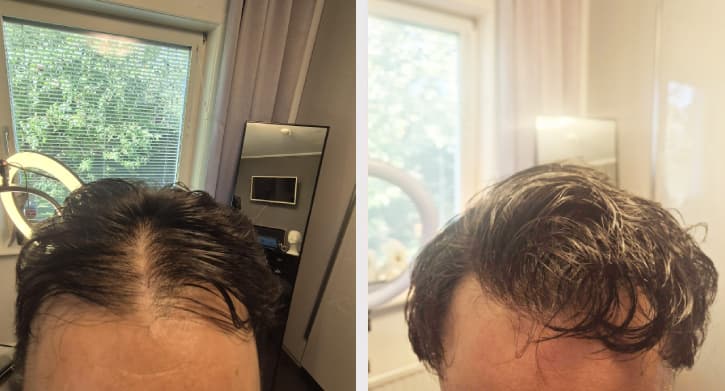 Scalp micropigmentation collage - Ali före efter