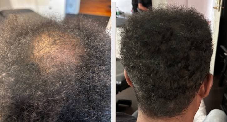 SMP behandling - Amanuel före efter transformation