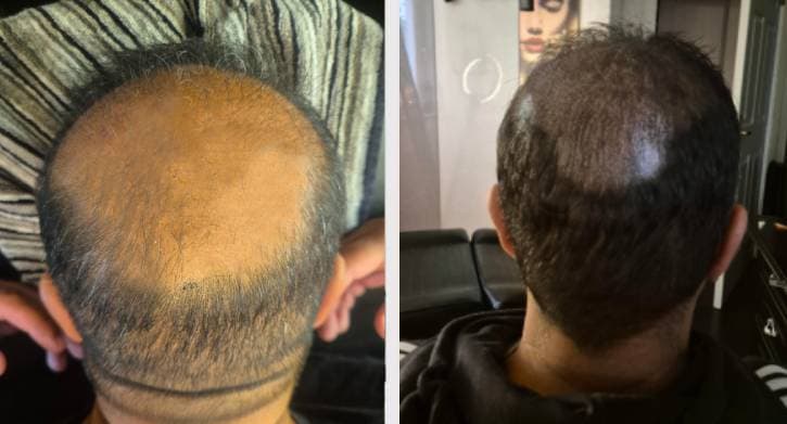 SMP naturlig hårlinje - Bayran resultat