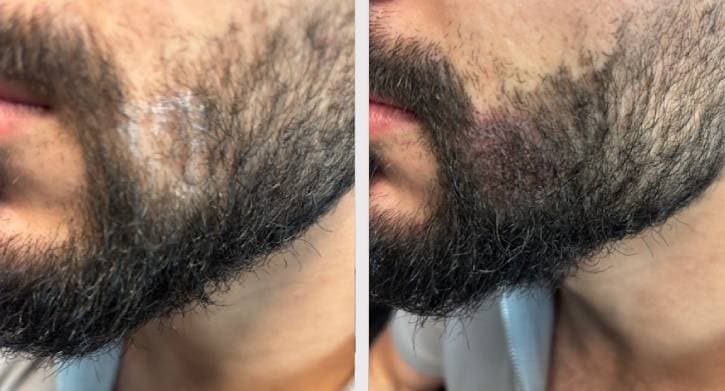 Skägg mikropigmentering - SMP behandling skägg
