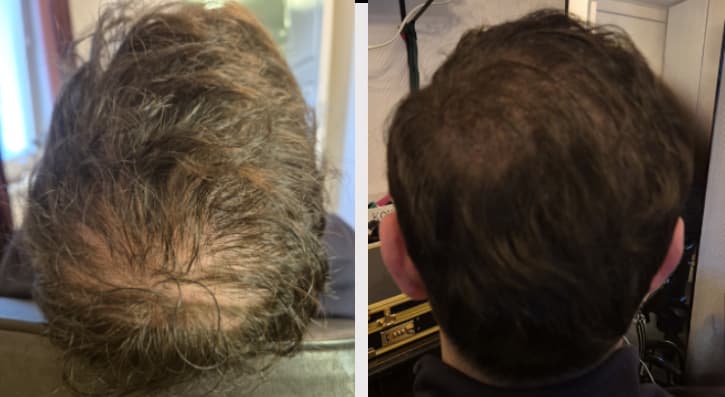Scalp micropigmentation - Dennis före efter
