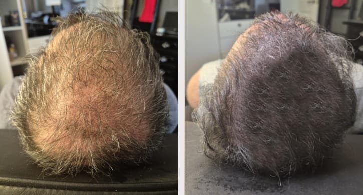 Hårtäthet man före efter - SMP densitet resultat Stockholm