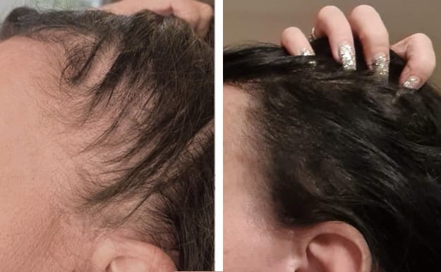 Hårtäthet kvinna före efter - SMP densitet behandling Stockholm