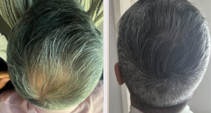 Hårpigmentering Stockholm - naturlig täthet