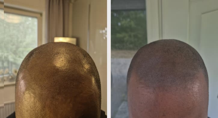 Skalp mikropigmentering - Hassan före efter