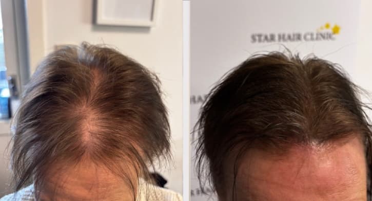 SMP densitet kvinna - Malin resultat