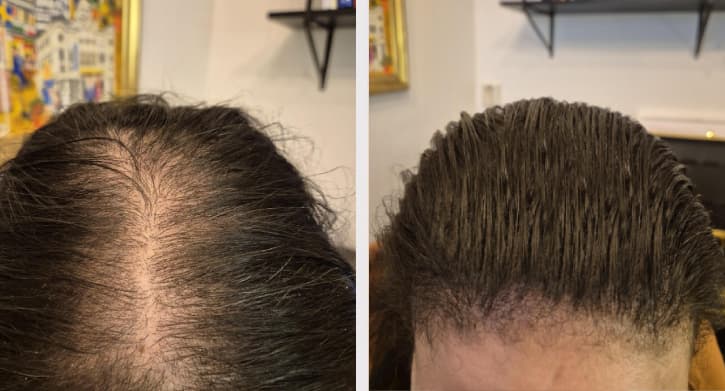 Skalp mikropigmentering - Ruby komplett resultat