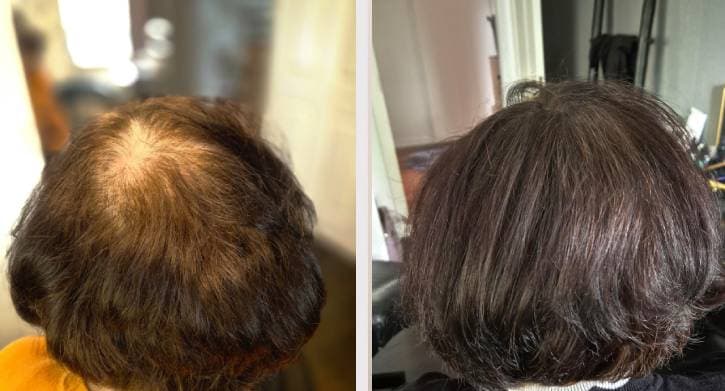 SMP densitet - Sanam före efter