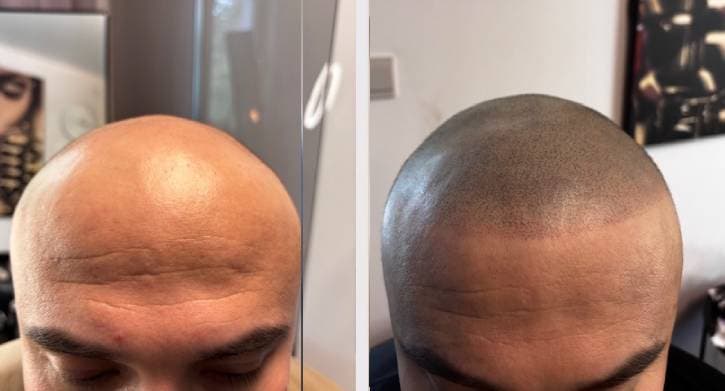 Scalp micropigmentation resultat Stockholm